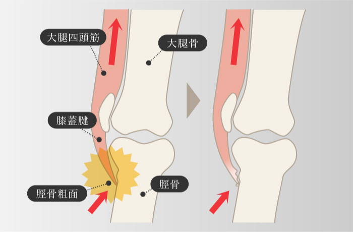オスグッド・シュラッター病